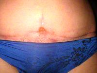 Tummy Tuck Treatment Candidate With Dr Darshan Shah, MD, Bakersfield Plastic Surgeon