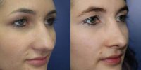 23-year-old woman treated with Rhinoplasty