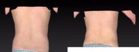 18-24 year old man treated with Liposuction