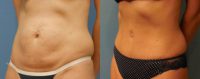 25-34 year old woman treated with Mini Tummy Tuck