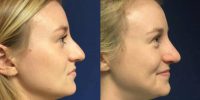 25-34 year old woman treated with Nose Surgery