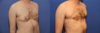 30 year old trans man treated with FTM Chest Masculinization Surgery
