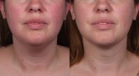36 year old had SmartLipo treatment to her neck in the office setting.