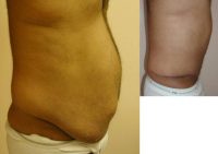 35-44 year old man treated with Male Tummy Tuck