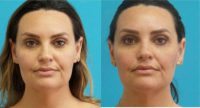 35-44 year old woman treated with liposuction of neck