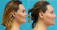 35-44 year old woman treated with Liposuction of neck
