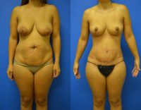 35-44 year old man treated with Mommy Makeover