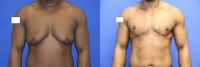 35-44 year old man treated with FTM Chest Masculinization Surgery