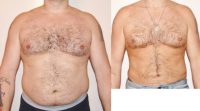 42 year old male liposuction