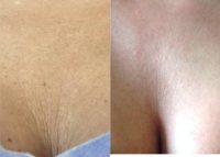 45-54 year old woman treated with Sculptra Aesthetic in the Chest