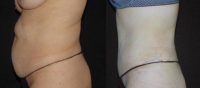 49 y/o female Treated with Drainless Tummy Tuck and Diastasis Recti Repair