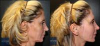 45-54 year old woman treated with Non-Surgical Neck Lift