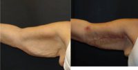 45-54 year old woman treated with Brachioplasty at one week