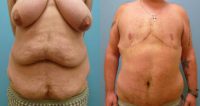 45-54 year old man treated with Breast Reduction with Free Nipple Graft, Tummy Tuck and Liposuction