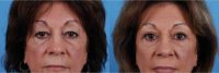 55-64 year old woman treated for Eye Bags