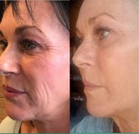 55-64 year old woman treated with Sculptra, SkinPen and Venus Viva