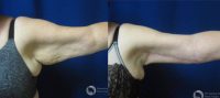 55-64 year old man treated with Arm Lift