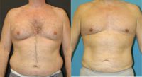 55-64 year old man treated with Liposuction
