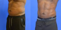 55-64 year old man treated with Liposuction with Abdominal Etching