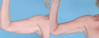 64 Year Old Female treated with Liposuction to the Arms
