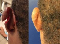 65-74 year old man treated with Ear Surgery