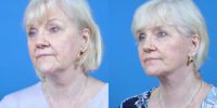 65-74 year old woman Facelift, Necklift, Co2 Peri oral