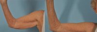 75 and up year old woman treated with Arm Lift