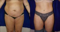 Abdominoplasty and liposuction with additional weight loss after the surgery