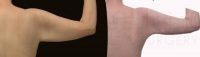 Body jet (water-assisted) liposuctioni of arms and brachioplasty after 100lb weight loss