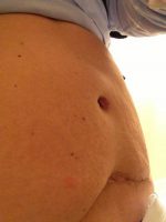 Breast Augmentation Tummy Tuck Before After Picture With Doctor Joubin Gabbay, MD, Beverly Hills Board Certified Plastic Surgeon