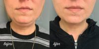 Chin Liposuction- 35-44 year old woman