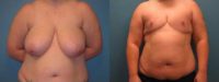 25-34 year old man treated with FTM Chest Masculinization Surgery