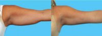 25-34 year old woman treated with Vaser Liposuction: Arms & Axilla