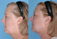 57 Year Old Female Treated for Lipodystrophy of the chin