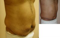 35-44 year old man treated with Male Tummy Tuck