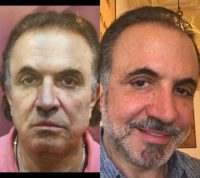 55-64 year old man treated with Facelift