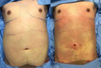25-34 year old man treated with Liposuction