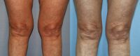 63-year-old woman treated with Liposuction of the Knees