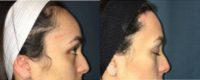 18-24 year old woman treated with Forehead Reduction