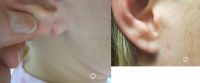 17 or under year old woman treated with Ear Lobe Surgery