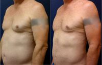 51 year old man treated with Liposuction Revision