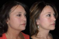 52 year old wanted facial rejuvenation