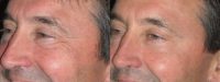 57 year old with deep crows feet treated with Botox