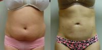 Laser Liposuction of the abdomen and love handles