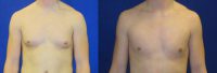 19 year old male complains of excess breast tissue