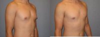 21 Year Old Gynecomastia (male breast reduction) Patient