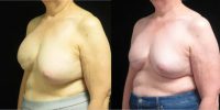 55-64 year old woman treated with Breast Reconstruction Revision