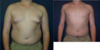 17 or under year old man treated with Male Breast Reduction