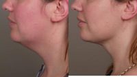 36 year old had SmartLipo treatment to her neck in the office setting.