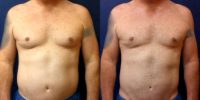 51 year old man treated with Liposuction Revision